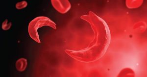 Sickle Cell Anaemia VS Sickle Cell Trait