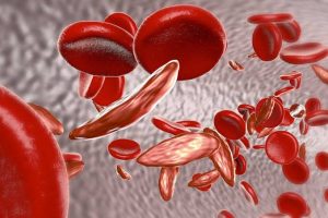 Sickle Cell Anaemia VS Sickle Cell Trait