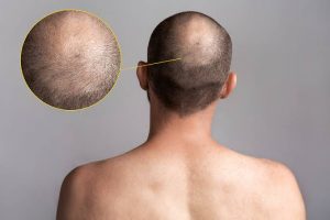 Alopecia