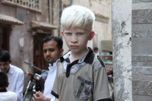 Albinism: The last words of an Albino
